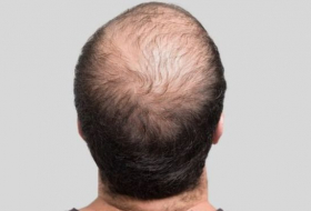 اكتشاف علاج جديد يعزز نمو الشعر ويقضي على الصلع
