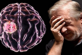 5 أعراض مبكرة لأورام الدماغ السرطانية