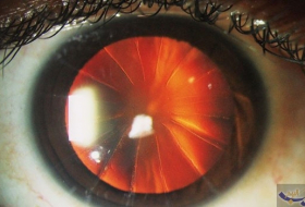أطباء يكتشفون نمطًا غريبًا ظهر في عين امرأة