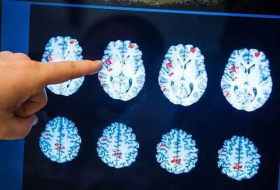 دماغ الرجل أم المرأة.. دراسة تكشف 