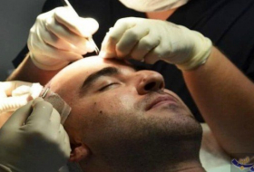 تقنية طبية جديدة تسمح بتخزين بُصيلات الشعر لـ