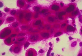 العلماء يكتشفون الخديعة الكبرى للخلايا السرطانية