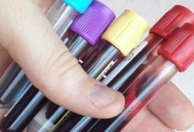 اكتشاف اختبار دم يُشخص سرطان البنكرياس في مراحله الأولى